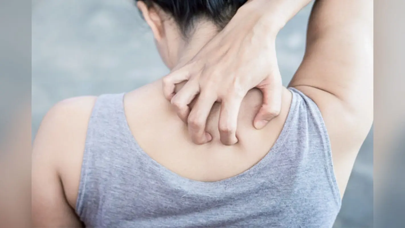 Home Remedies Heat Rash: गर्मियों में हैं घमौरियों से तंग तो तुरंत अपनाएं ये घरेलू नुस्खे