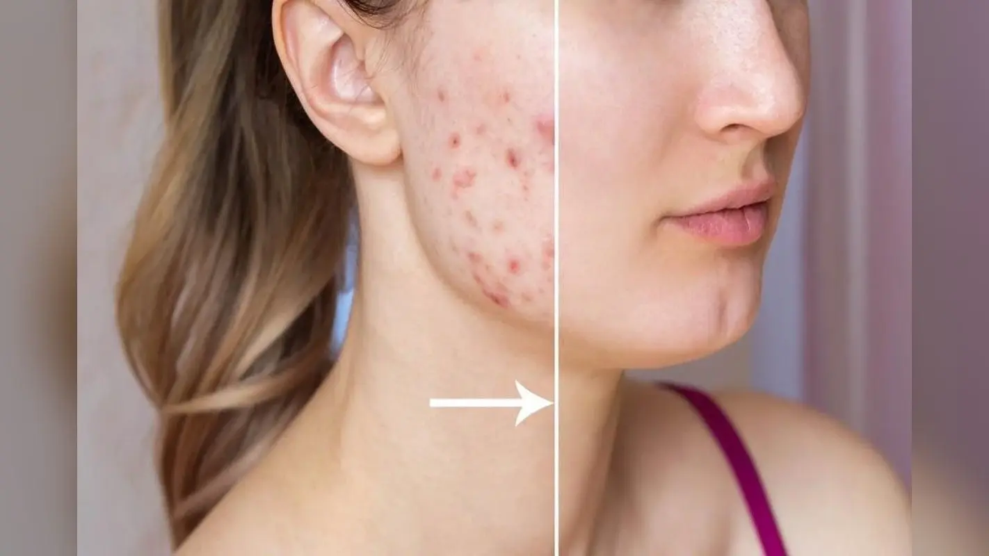 Home Remedies for Acne Scars: स्किन केयर एक्सपर्ट्स से जानिए मुंहासों के दाग से कैसे छुटकारा पा सकते हैं?