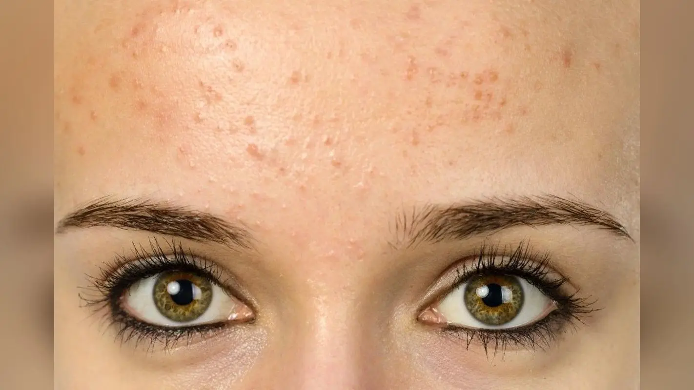 Pimples on Forehead in Summer: गर्मी में फोरहेड पर होते हैं दाने तो स्किन एक्सपर्ट के बताए इन टिप्स को करें फॉलो