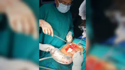 आरोग्यम में लिवर की हाइडैटिड बीमारी का सफल ऑपरेशन