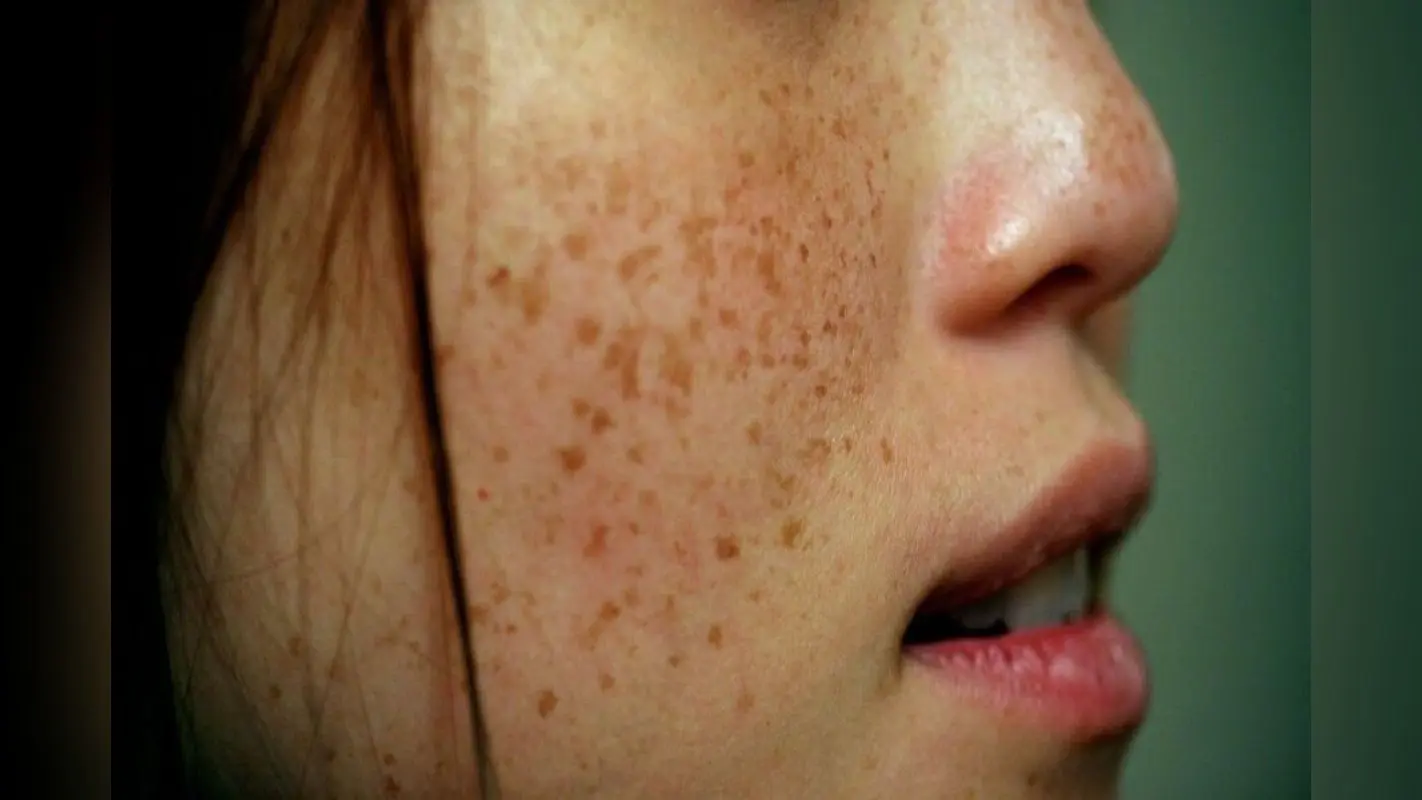 Freckles Face: रातों रात झाइयां कम करने का उपाय, ब्यूटी एक्सपर्ट से जानिए
