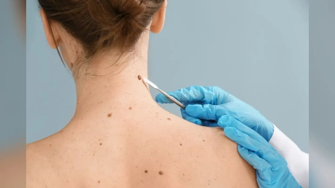 Skin Cancer: अल्ट्रावायलेट लाइट के संपर्क में आने से बढ़ रहा है स्किन कैंसर का खतरा, डॉक्टर से जानिए इसके लक्षण