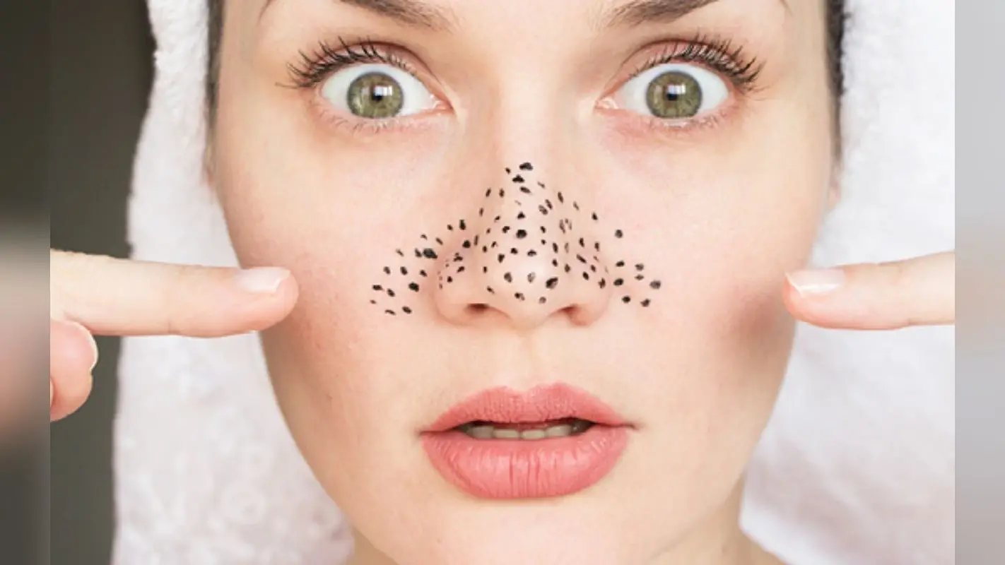 Blackheads: ब्लैकहेड्स हटाना हो जाएगा बिल्कुल आसान, अभी जानें इन होम रेमेडीज के बरे में