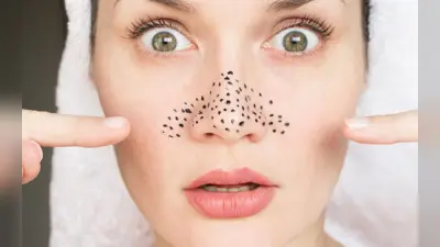 Blackheads: ब्लैकहेड्स हटाना हो जाएगा बिल्कुल आसान, अभी जानें इन होम रेमेडीज के बरे में