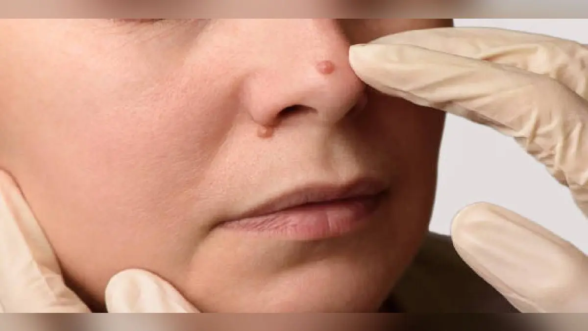 Remove to Unwanted Moles: बिना सर्जरी के हटाएं अनचाहे तिल, करें ये घरेलू उपाय