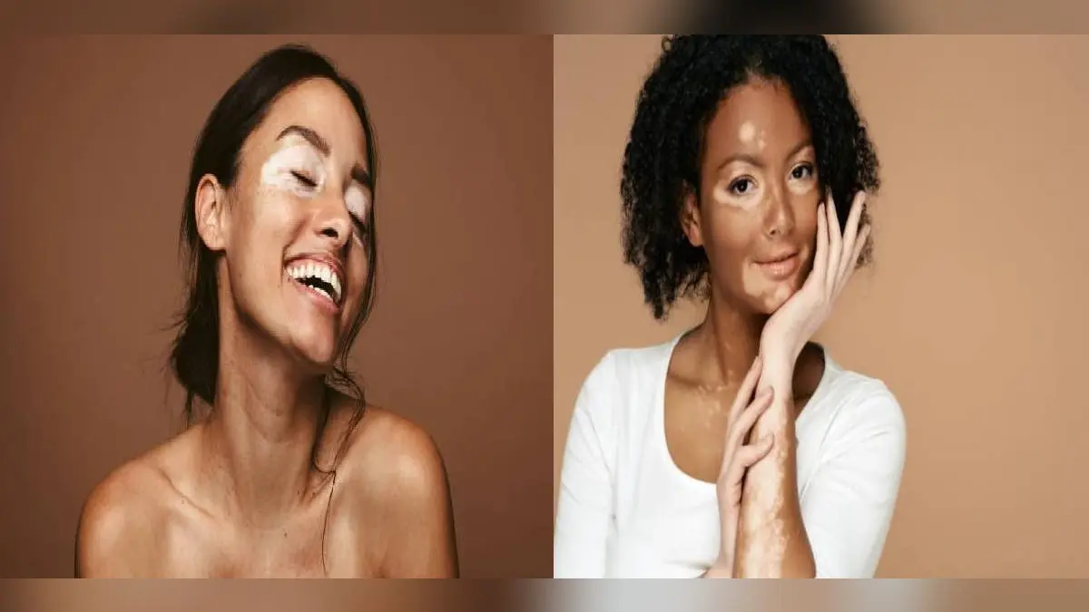 World Vitiligo Day 2024: क्यों होते हैं शरीर पर सफेद दाग, जानें इस दिन को मनाने का उद्देश्य