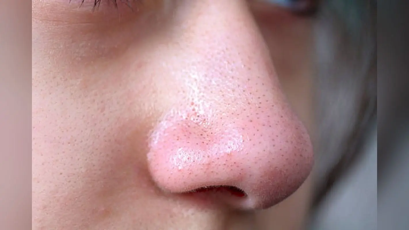 Skin Care Tips: ये हैं ब्लैकहेड्स हटाने के कुछ घरेलू उपाय