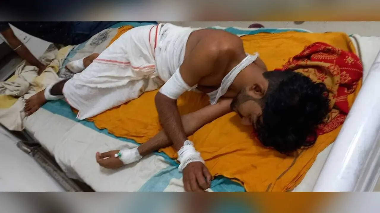 बड़े भाई ने छोटे भाई के उपर फेंका खौलता तेल, बुरी तरह झुलसा, अस्पताल में भर्ती