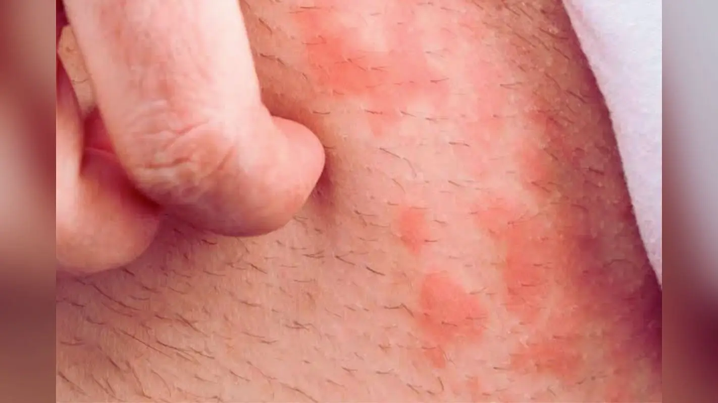 Groin fungal infection: ग्रोइन फंगल संक्रमण होता क्या है और इससे बचा कैसे जा सकता है?
