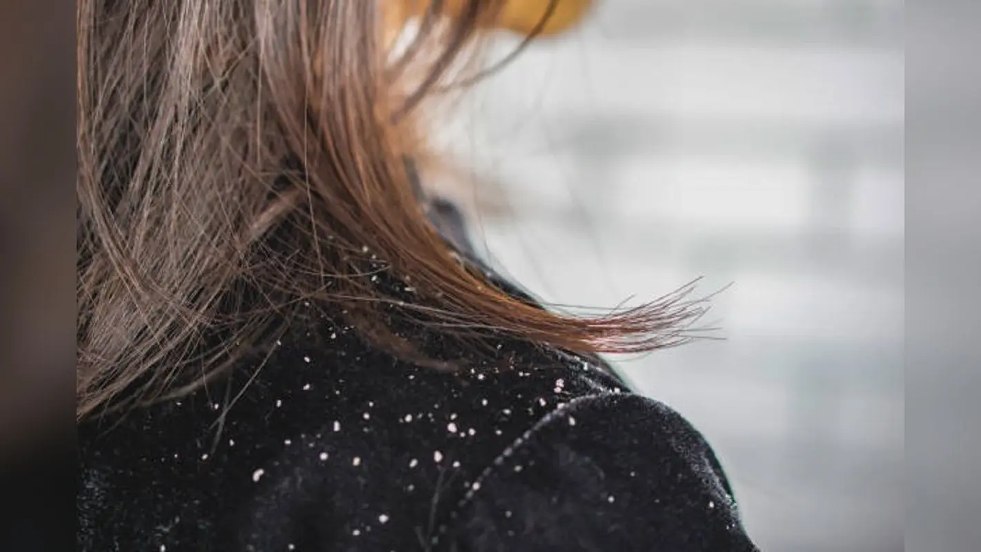 Beauty Tips : अब शैंपू की जरूरत नहीं,अपनाएं यह ट्रिक दो दिन में मिलेगा डैंड्रफ से छुटकारा