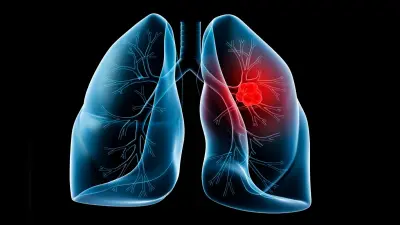 Lung Cancer : नॉन स्मोकर्स को ज़्यादा होता है लंग कैंसर का खतरा, क्या है इसके पीछे की वजह