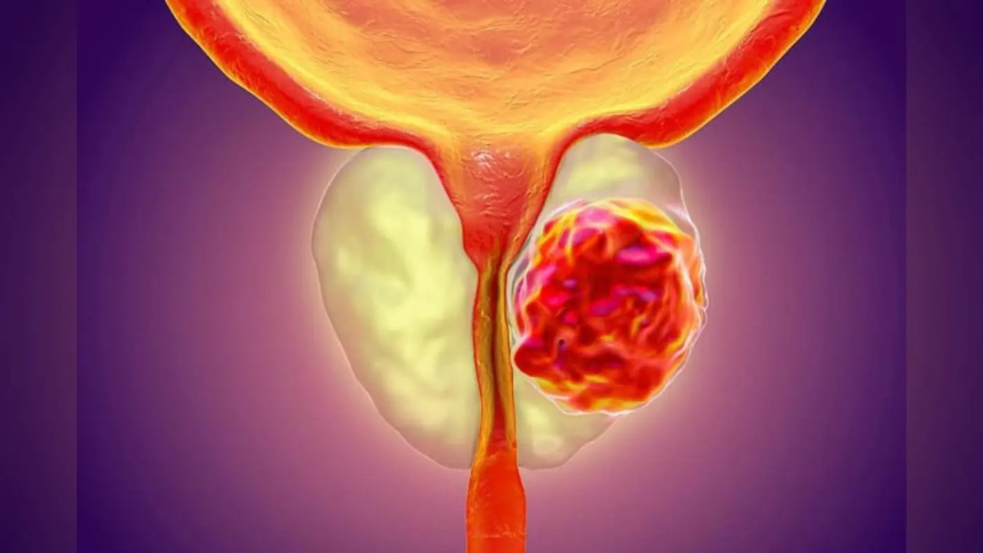 Prostate cancer: प्रोस्टेट कैंसर समझ, रोकथाम और इलाज