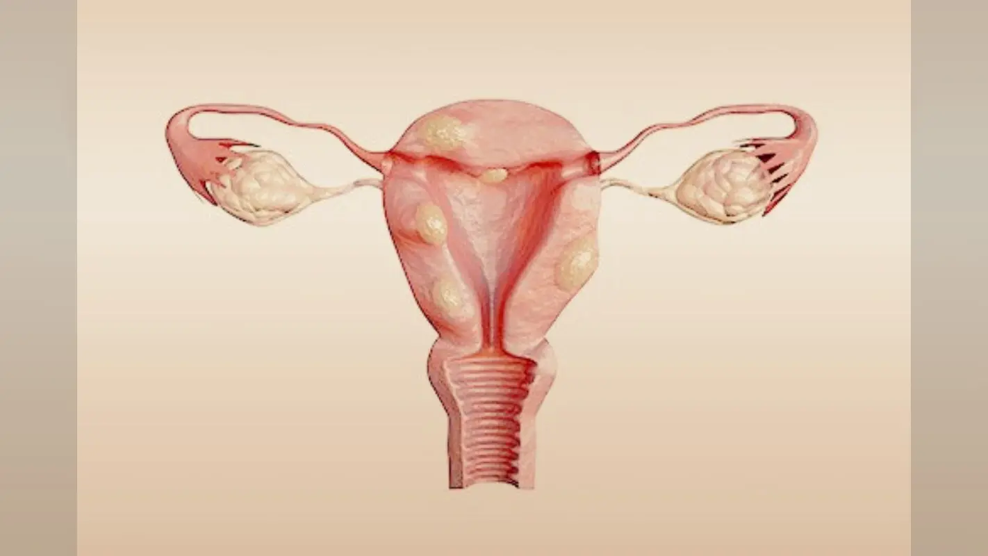 Uterine fibroids: गर्भाशय फाइब्रॉइड्स की वृद्धि को कैसे रोकें