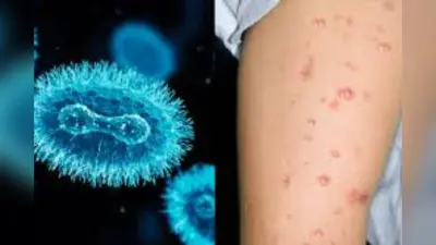 Monkeypox virus: कई देशों में फैला मंकीपॉक्स, जानें बचने के उपाय