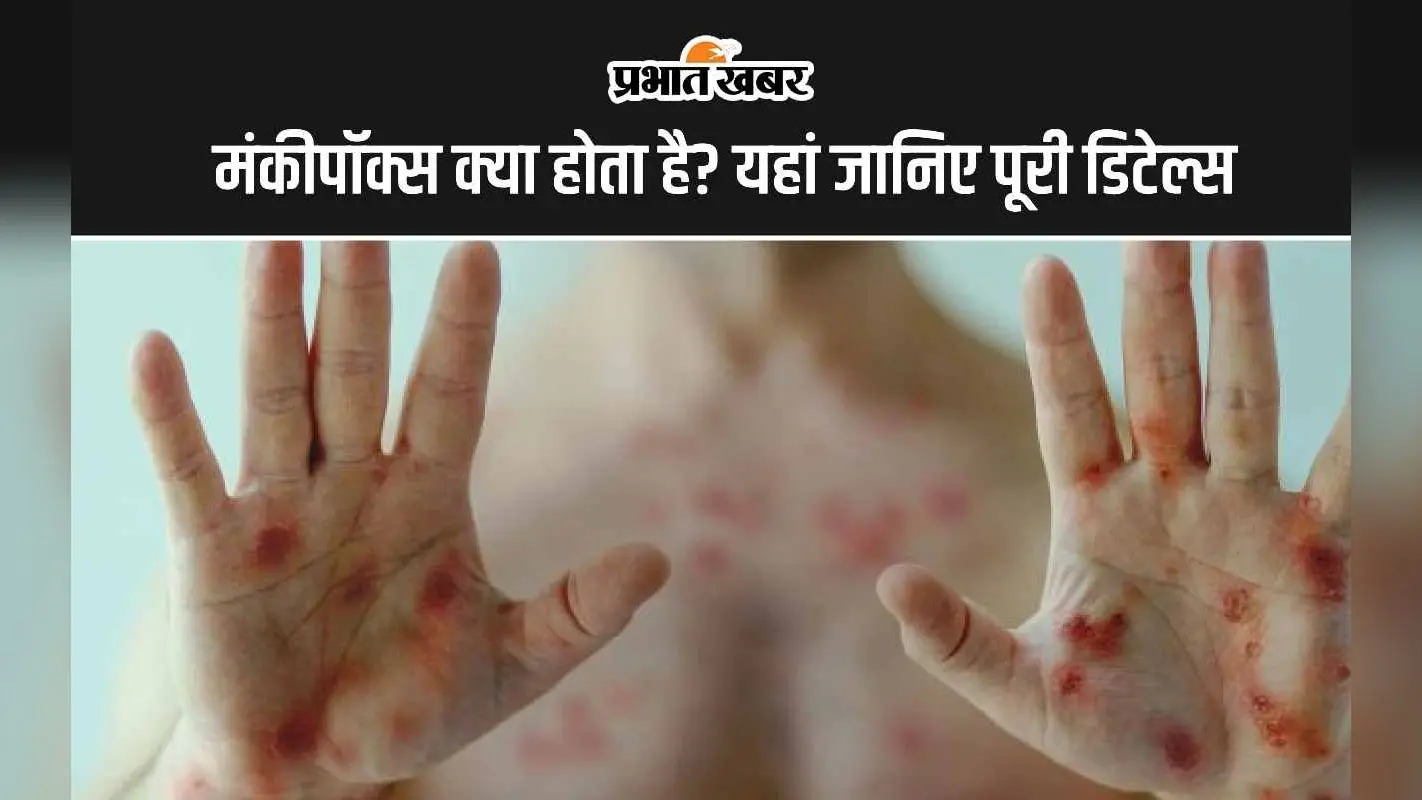 Monkeypox scare: मंकीपॉक्स क्या होता है? यह कैसे फैल रहा है, जानिए एमपॉक्स के लक्षण और बचाव के उपाय