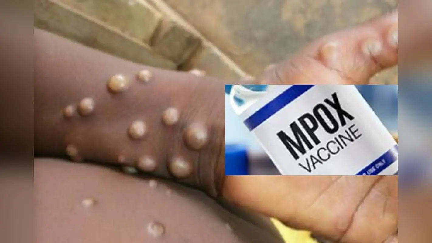 Mpox virus: पहले बुखार फिर चेहरे पर निकलता है दाना, मंकीपॉक्स ने बढ़ा दी दुनिया की टेंशन