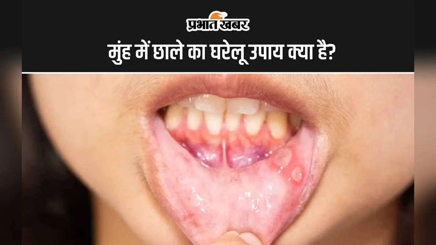 Mouth Tips: मुंह में छाले का घरेलू उपाय क्या है?