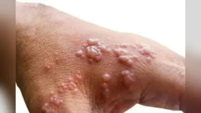 M-pox virus: मंकीपॉक्स वायरस के कारण, प्रभाव और उपचार