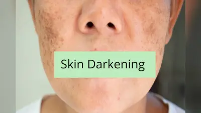 Skin Darkening: इस विटामिन की कमी से चेहरा पड़ जाता है काला