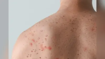 राज्य में मंकी पॉक्स को लेकर एडवाइजरी जारी