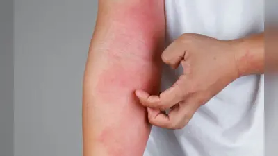 Monsoon Skin Care: बरसात के मौसम में बढ़ने वाली पिंपल्स की समस्या से छुटकारा दिलाएंगे, ये घरेलू उपाय