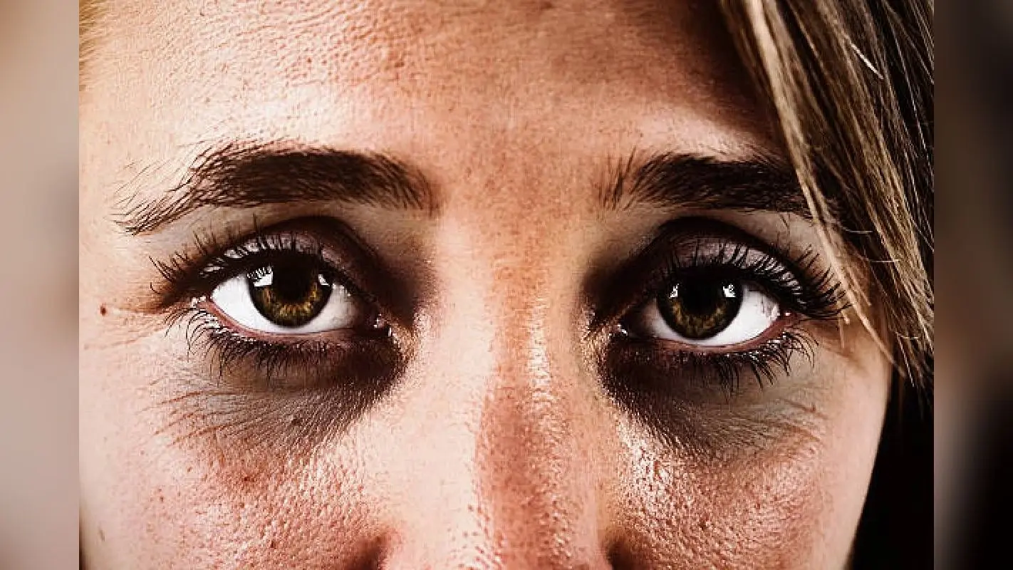 Dark Circles से कम हो गई है खूबसूरती, आजमाएं ये घरेलू उपाय