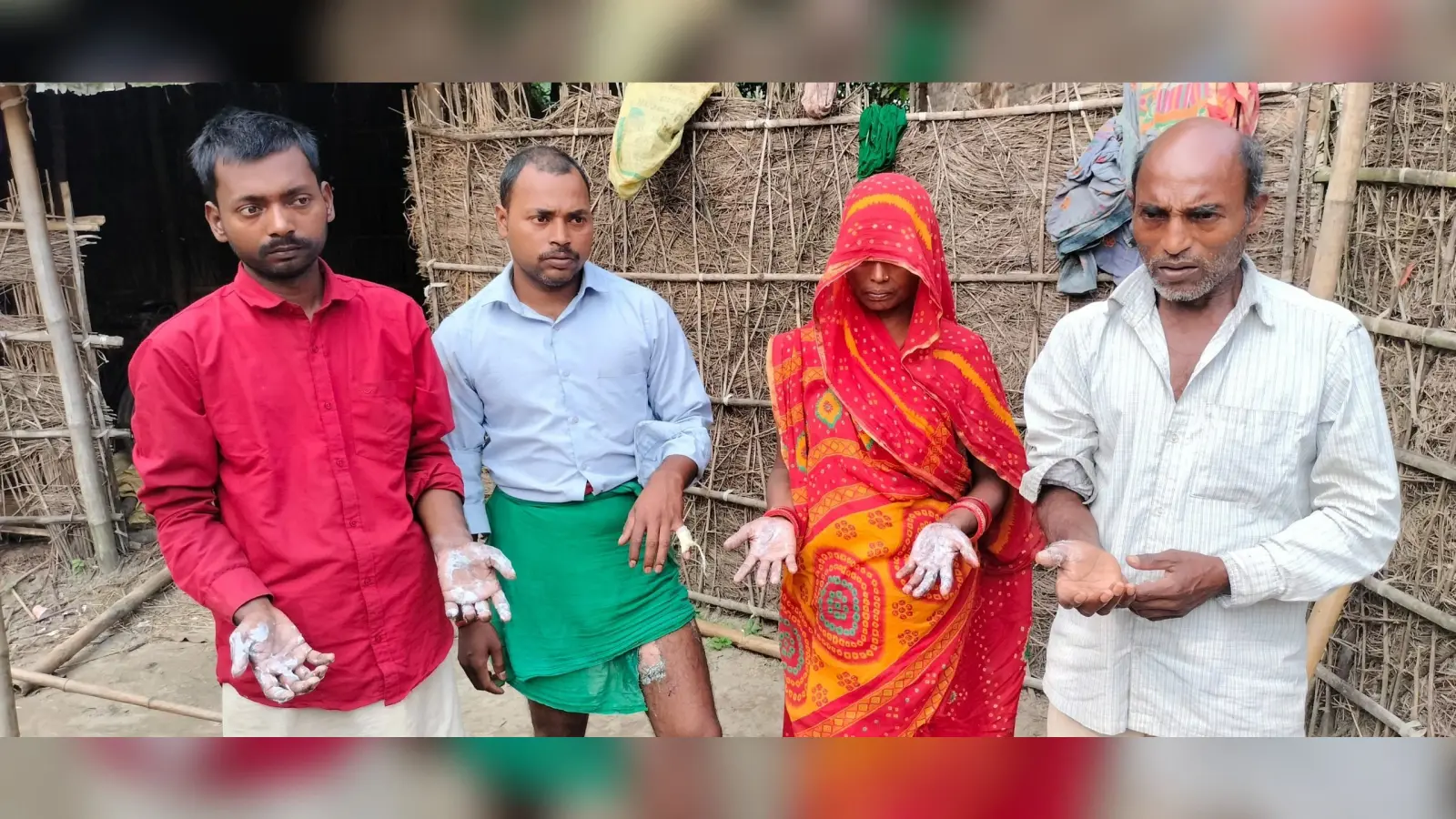 युवक के जेब में विस्फोट हुआ मोबाइल, एक महिला सहित परिवार के चार लोग झुलसे