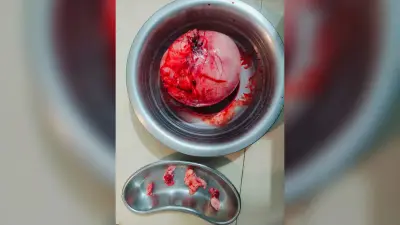 दो किलो का शिष्ट निकाल महिला को दिया जीवन दान