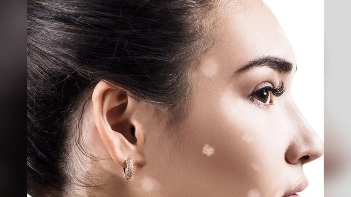 Home Remedies for White Spots on Skin: त्वचा पर सफेद दाग को दूर करने के लिए अपनाएं ये घरेलू नुस्खे