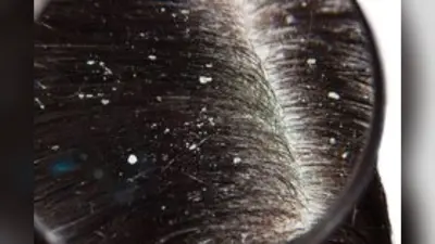 Home Remedies For Dandruff : सर्दी में डैंड्रफ को कहें अलविदा, अपनाएं ये सरल घरेलू नुस्खे