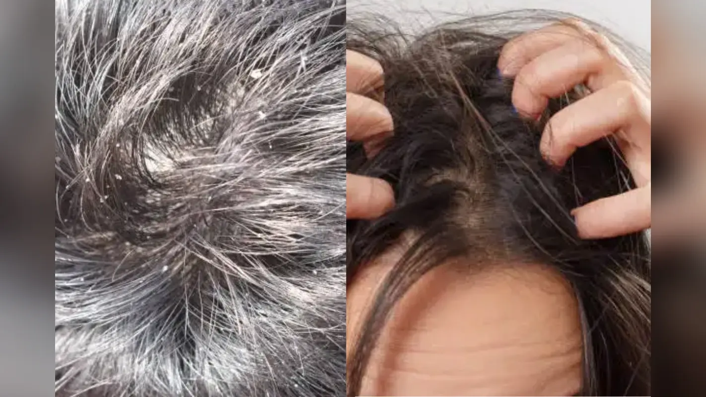 Winter Dandruff Remedies: सर्दियों में डैंड्रफ से है परेशान, इन घरेलू नुस्खों में है इस समस्या का समाधान