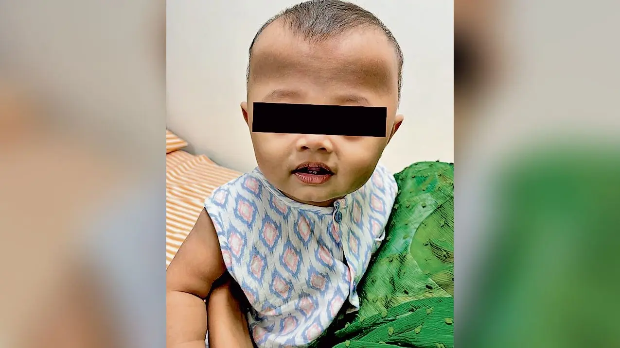 जटिल बीमारी से जूझ रहे बांग्लादेशी शिशु का हुआ सफल इलाज
