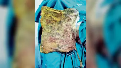 ऑपरेशन के दौरान मरीज के पेट में छूट गया था कपड़ा, डॉक्टरों ने निकाला
