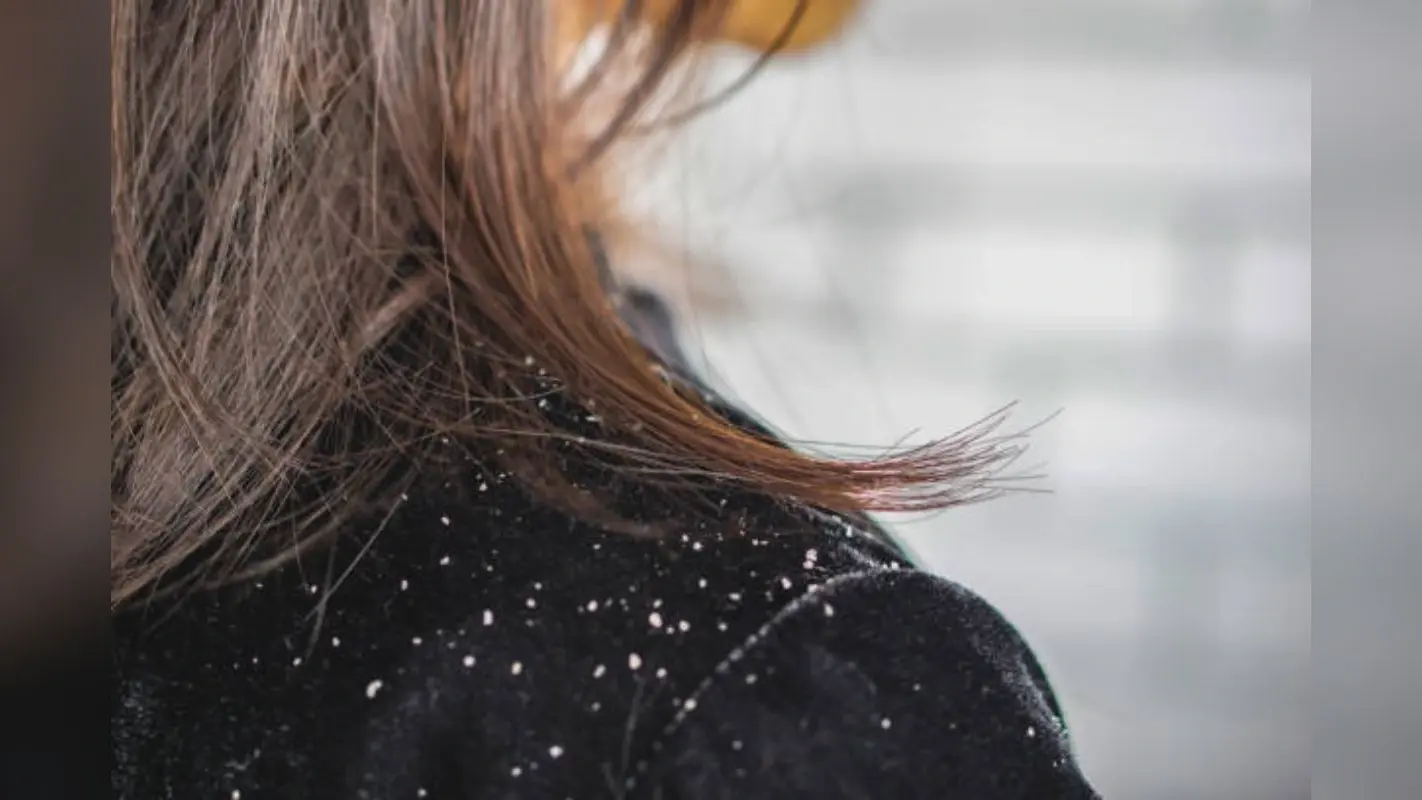 Hair Care Tips: सर्दियों में अब नहीं सताएगी डैंड्रफ की चिंता, इस तरह रखें अपने बालों का ख्याल