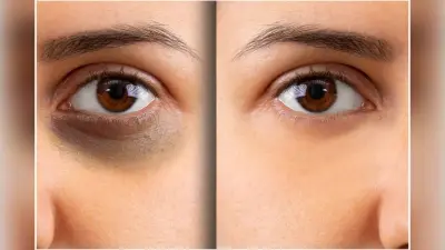 Dark Circle Remedies : डार्क सर्कल्स को कहें अलविदा, अपनाएं ये घरेलू नुस्खे