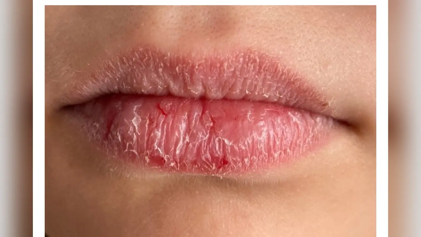 3 Home Remedies for Dry lips: फटे होंठों से पाएं छुटकारा जानें 3 आसान घरेलू उपाय