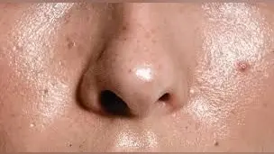 Skincare Tips: चेहरे की झाइयों से हैं परेशान, तो अपनायें यह घरेलू नुस्खें