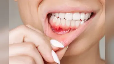 Causes Of Mouth Ulcers: मुंह के छालों से है परेशान तो अनदेखा करने की गलती न करें