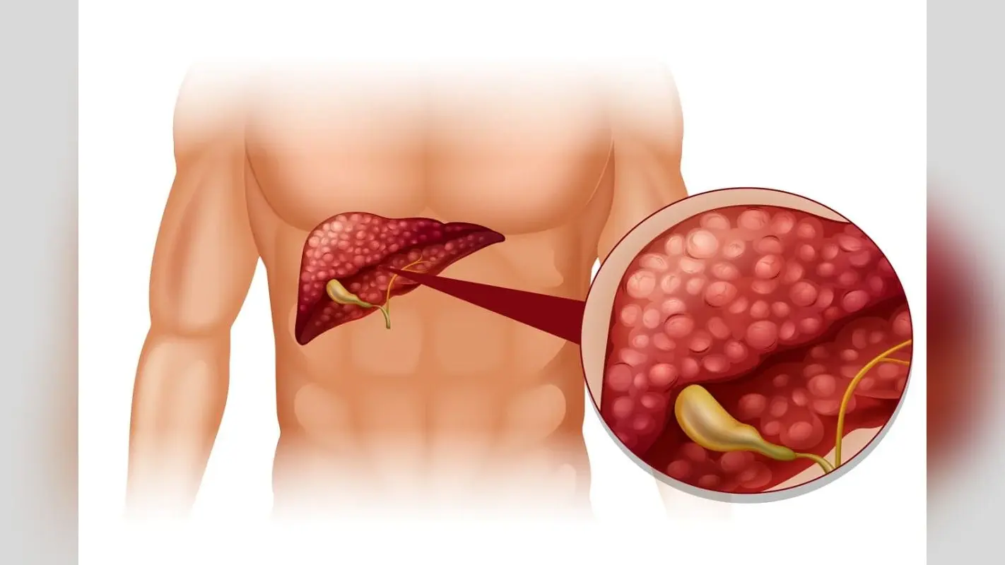 Fatty Liver: समय रहते अपने लाइफस्टाइल को सुधार लीजिए वरना फैटी लीवर बहुत बीमार कर देगा, जानिए इसके बारे में