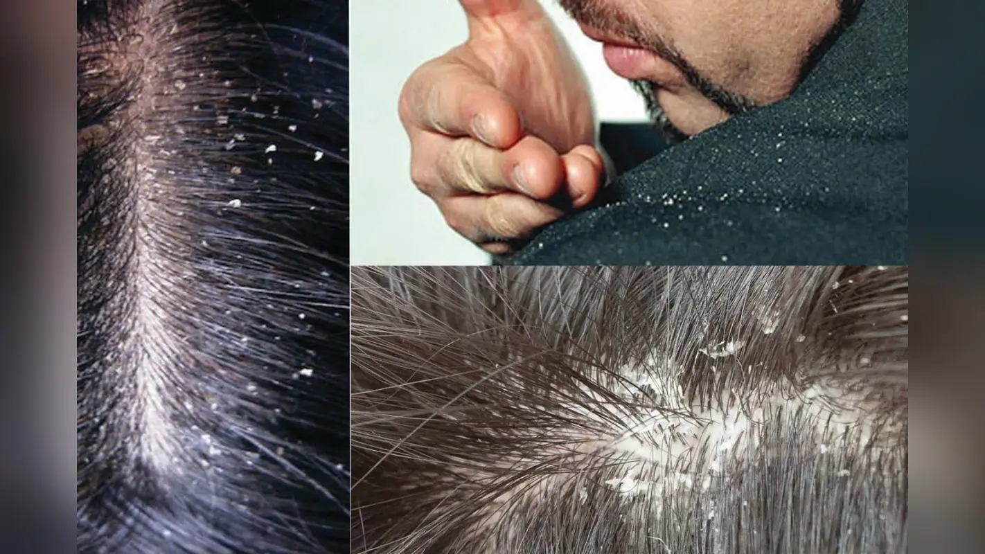 Curd For Dandruff: स्कैल्प पर जमे हुए डैंड्रफ को हटाने के लिए करें दही का इस्तेमाल, जानें सही तरीका