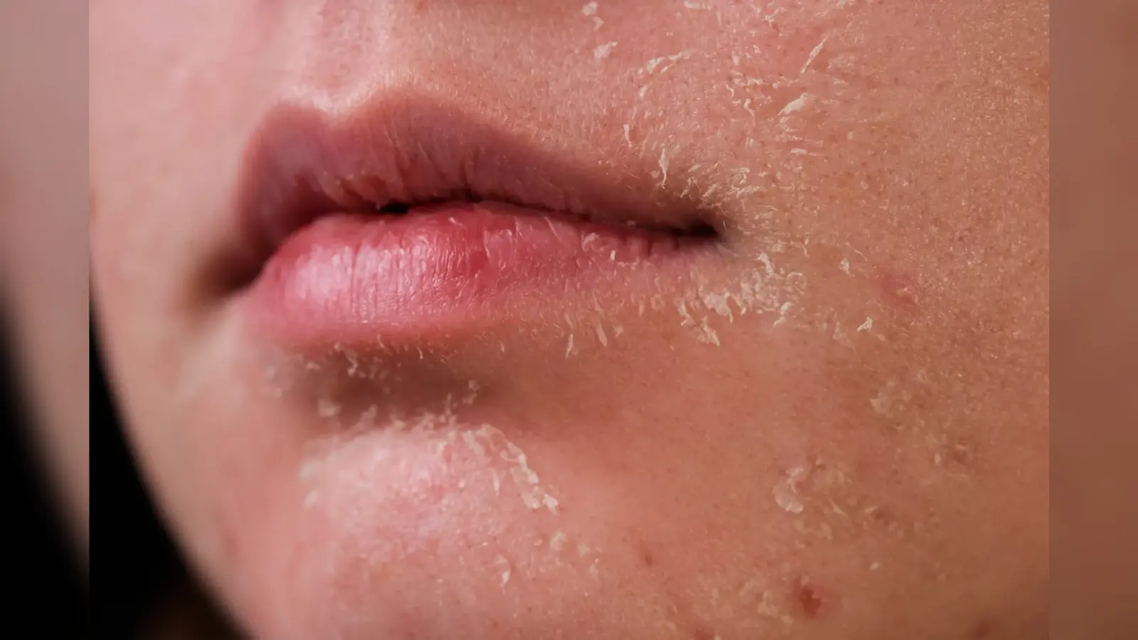 Dry Skin Care: ड्राई स्किन से परेशान हैं तो रात को बस ये चीज स्किन पर लगा लें, चमक उठेगा चेहरा