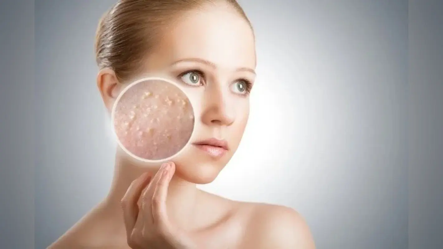 Home Remedies For Acne: गर्मी में चेहरे पर हो रहे छोटे छोटे दाने तो अपनाएं ये घरेलु नुस्खे, दूर होगी समस्या
