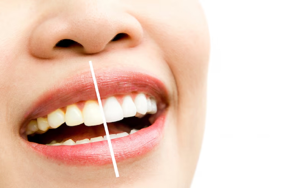 Whitening Teeth: महंगे प्रोडक्ट नहीं, ये घरेलू नुस्खे बना देंगे आपके दांत मोती जैसे सफेद