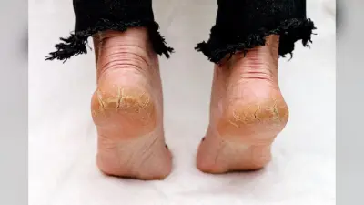 Home Remedies For Cracked Heels: गर्मियों में फटी एड़ियों से परेशान? अपनाएं ये असरदार घरेलू उपाय