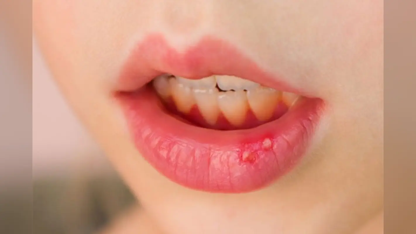 Mouth Ulcer: सिर्फ पाचन नहीं मुंह में छाले होने के हो सकते हैं अन्य कारण भी