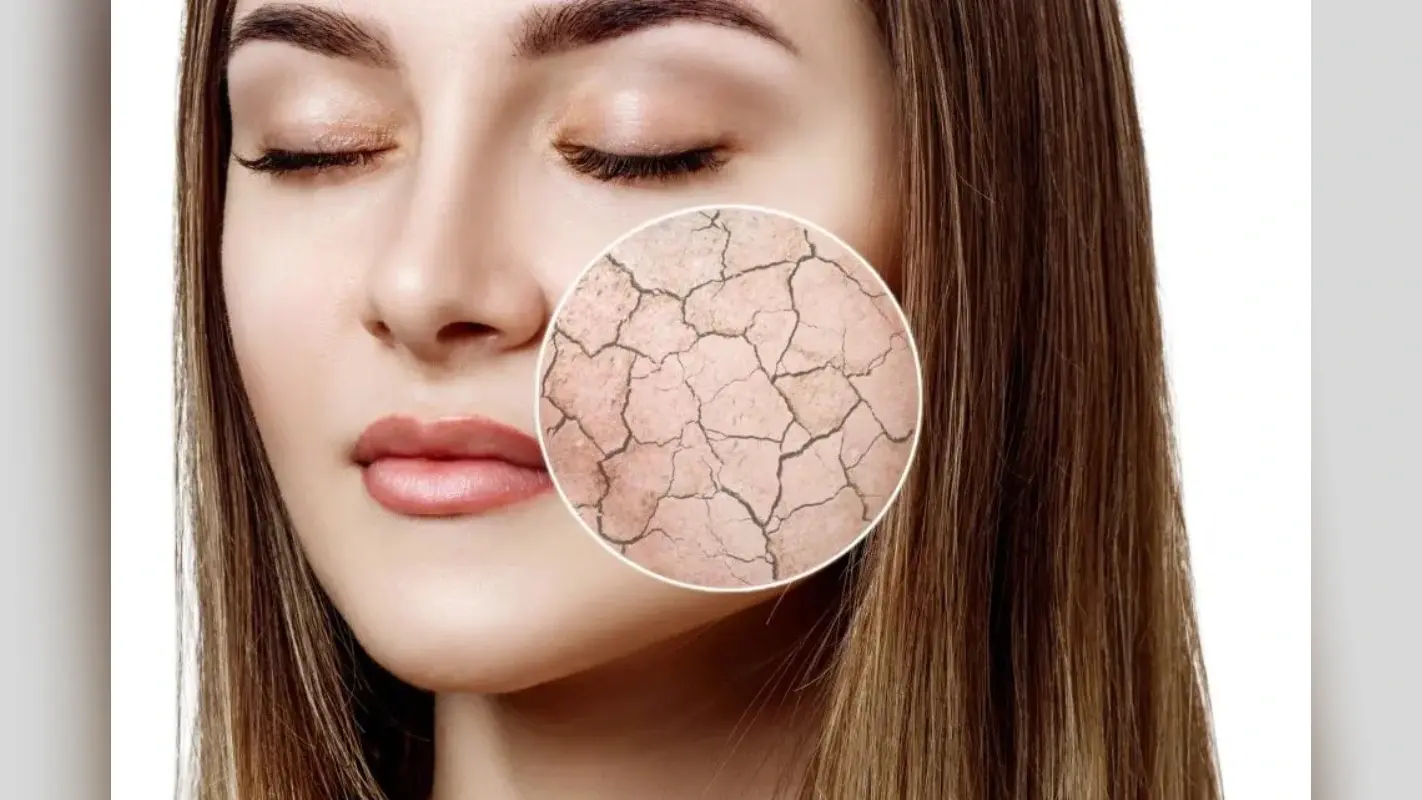 Dry Skin Home Remedies: रूखी स्किन का इलाज है किचन में छुपा, जानिए 5 देसी उपाय
