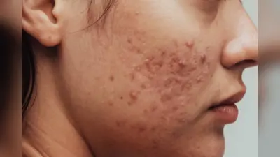 Skin Products For Pimples: पिंपल्स से परेशान हैं? जानिए कौन से स्किन प्रोडक्ट्स सही हैं आपके लिए