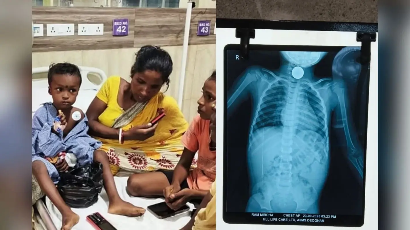 देवघर AIIMS के डॉक्टरों का कमाल, 15 मिनट में निकाला बच्चे के गले में फंसा 10 रुपये का सिक्का