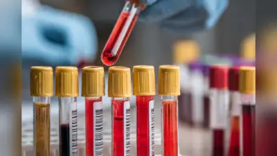 New Blood Test : नई ब्लड टेस्ट से सिर और गले के कैंसर का पता 10 साल पहले लगाना संभव