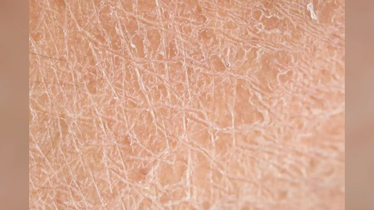 Best Home Remedies for Flaky Skin Treatment: फ्लीकी और झुर्रियों वाली त्वचा के लिए 5 बेहतरीन घरेलू नुस्खे